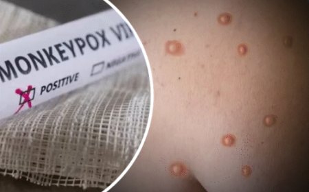 केरल में मंकीपॉक्स का मरीज मिला, UAE से लौटा था:9 सितंबर को Mpox के स्ट्रेन वेस्ट अफ्रीकन क्लेड 2 का मरीज मिला था