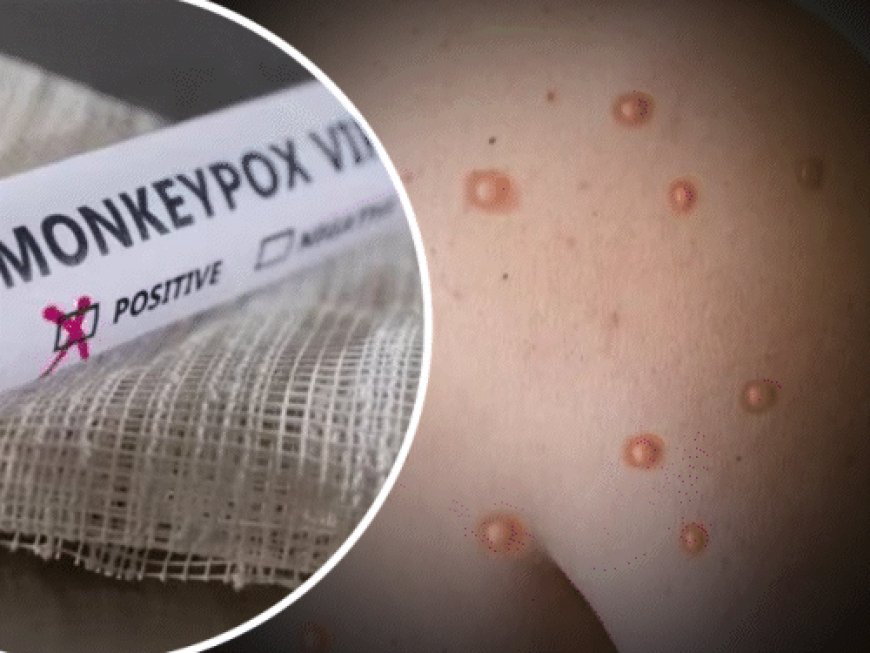 केरल में मंकीपॉक्स का मरीज मिला, UAE से लौटा था:9 सितंबर को Mpox के स्ट्रेन वेस्ट अफ्रीकन क्लेड 2 का मरीज मिला था